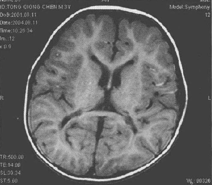 第一節(jié) 正常頭顱MRI解剖與小兒頭顱MRI的特點(diǎn)